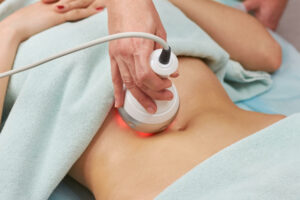 Woman receiving radio frequency skin tightening treatment from esthetician at medspa